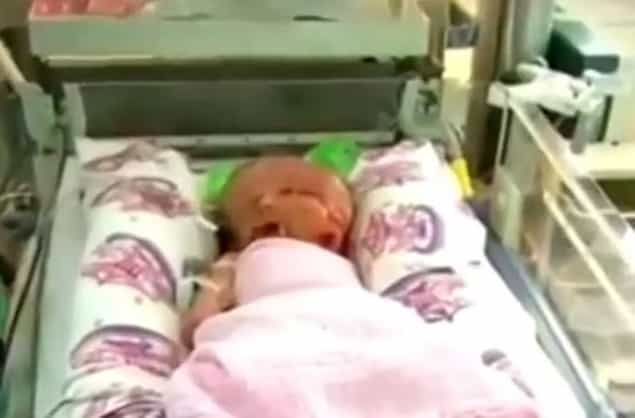 Australian Woman Gives Birth To Rare Conjoined Twins Who Share A Body But Have Two Faces Australian Woman Gives Birth To Rare Conjoined Twins Who Share A Body But Have Two Faces