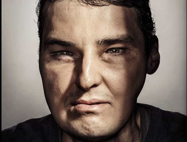 Shot-Gun Victim Who Had Face Transplant Models For GQ Magazine Shot-Gun Victim Who Had Face Transplant Models For GQ Magazine
