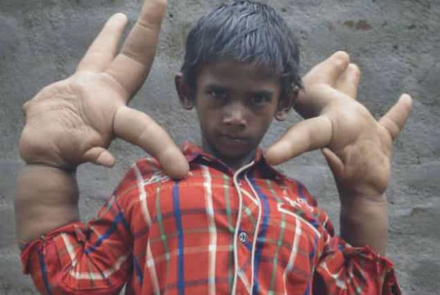 Boy Shunned From School After His Hands Grow Larger Than His Head Boy Shunned From School After His Hands Grow Larger Than His Head