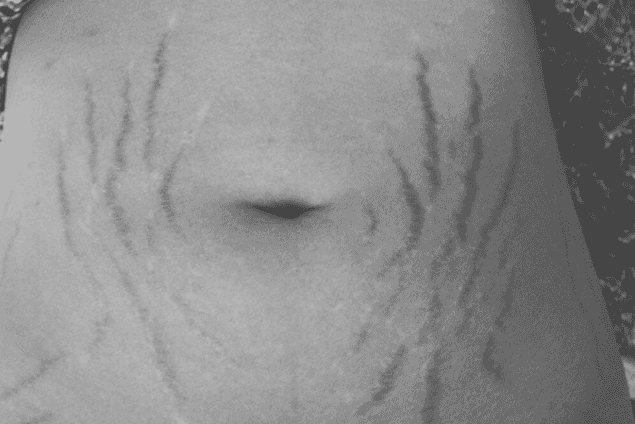 PICS: Love Your Lines Instagram Account Celebrates The Beauty Of Stretch Marks