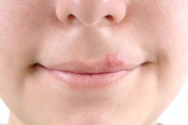 Having a Cold Sore Doubles The Risk of Alzheimer’s According to New Study Having a Cold Sore Doubles The Risk of Alzheimer’s According to New Study