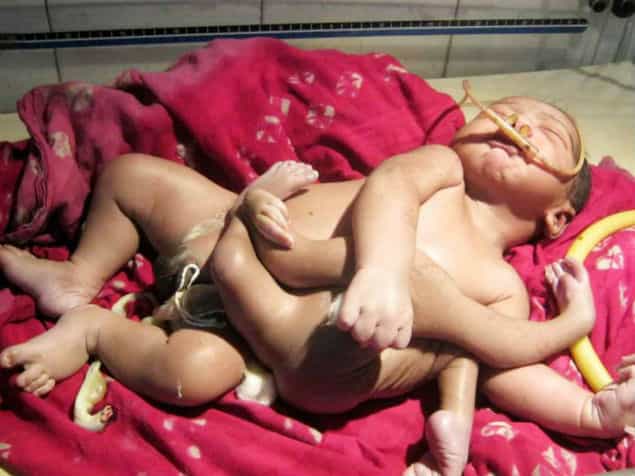 Indian ‘God Baby’ Born With Eight Limbs