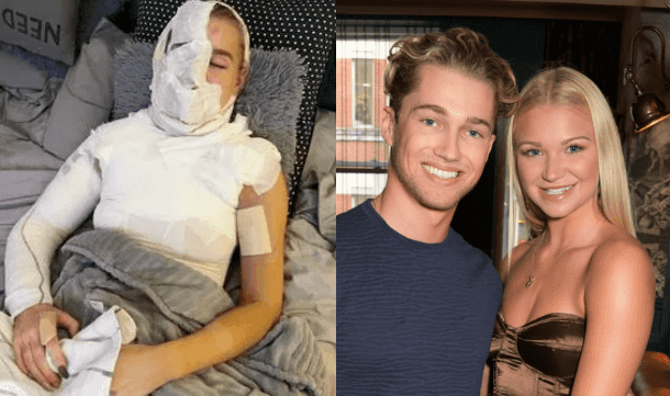 Abbie Quinnen, AJ Pritchard’s partner, pictured since suffering third degree burns Abbie Quinnen, AJ Pritchard’s partner, pictured since suffering third degree burns