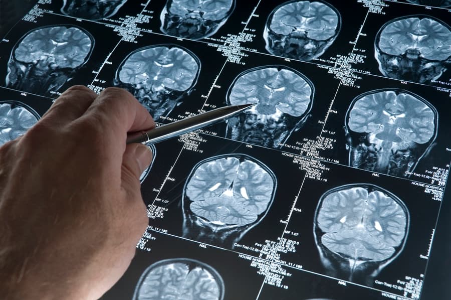 Do You Have a Manly Brain? Bits of Male DNA is Regularly Found in The Female Brain