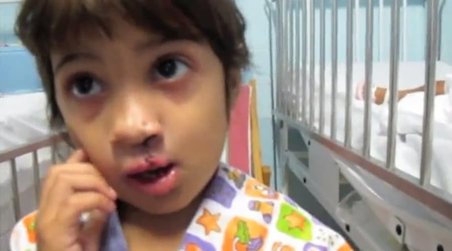 Operation Smile: Little Girl Sees Herself For The First Time After Undergoing Cleft Lip Surgery