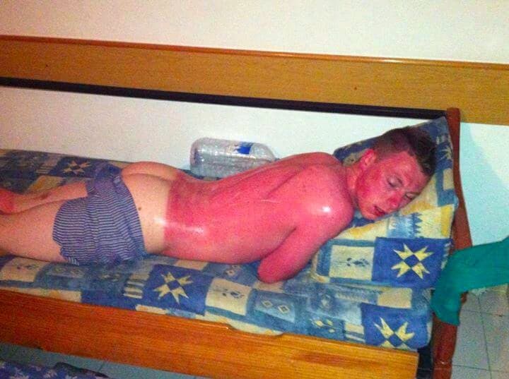 PIC: Possibly the Worst Sunburn You’ll Ever See