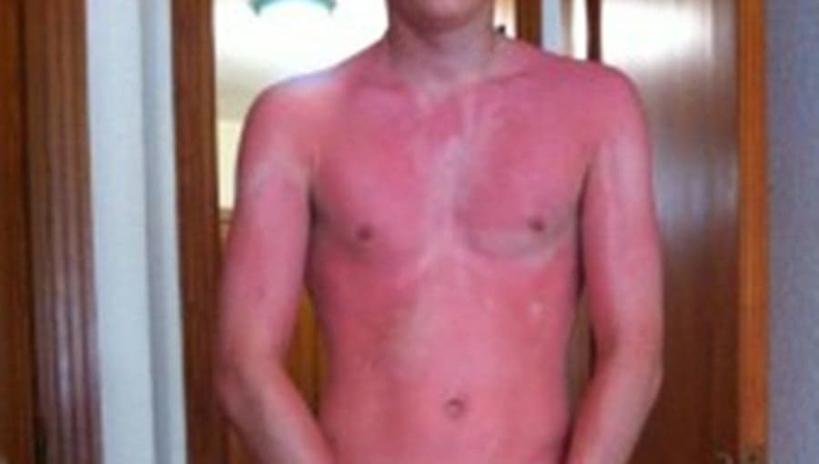 PHOTO: OUCH! The Photo Definition Of Why You Should Wear Sunscreen