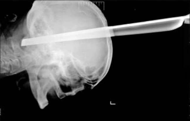 Bizarre X-Ray: Man Survives Metal Stool Leg Through His Head After Bar Brawl