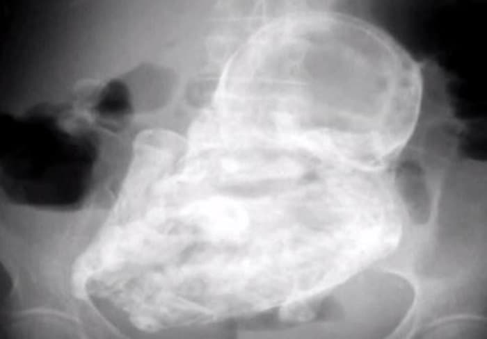 82-Year-Old Woman Carried Calcified Foetus For 40 Years