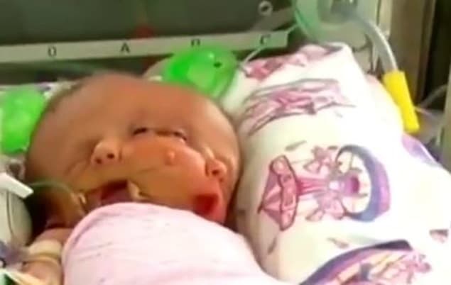 ‘Miracle’ Conjoined Twins Hope and Faith Have Passed Away, 19 Days Old