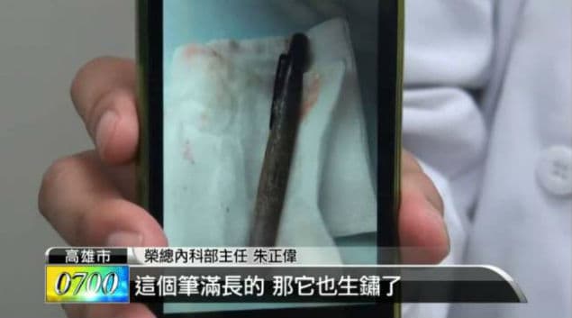 This Can’t Be Write? Woman Finds Pen Lodged In Stomach For Six Months
