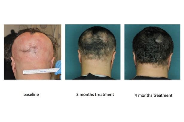Alopecia Drug Restores Hair In Just Five Months