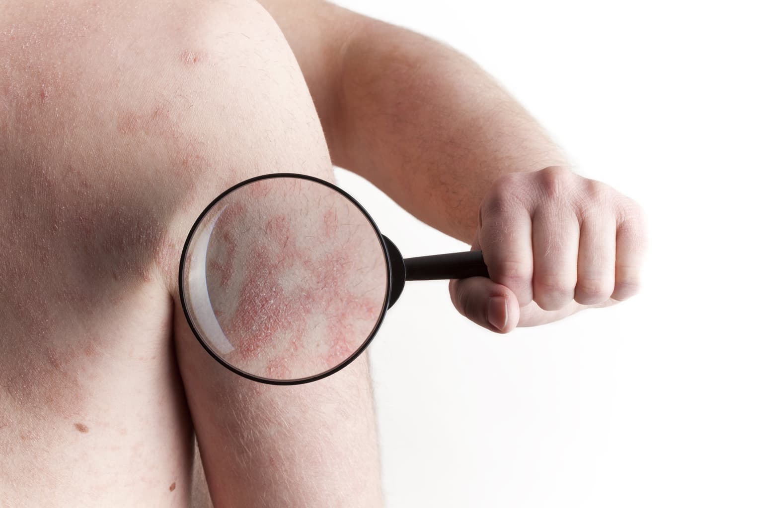29th October Marks World Psoriasis Day
