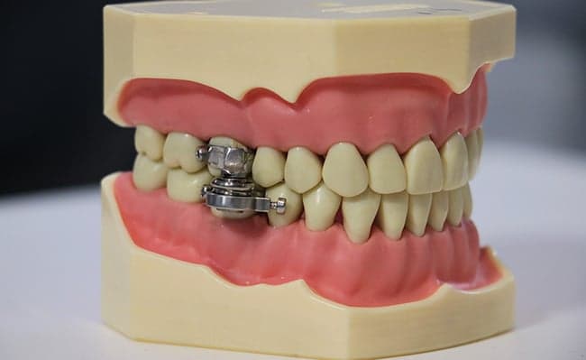 Weight loss device that clamps jaw shut criticised as “torture”