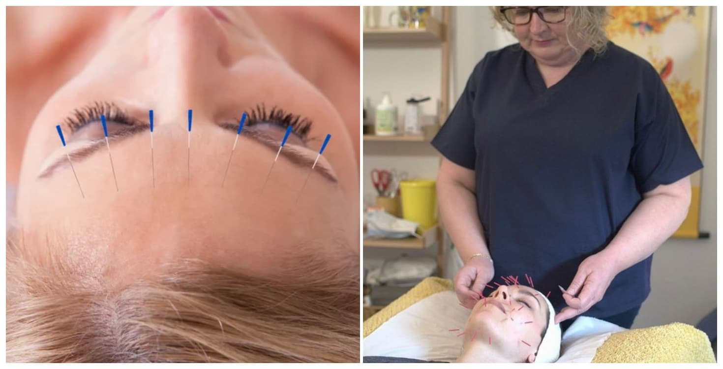 Like botox, but all natural: I tried cosmetic acupuncture and here’s what happened