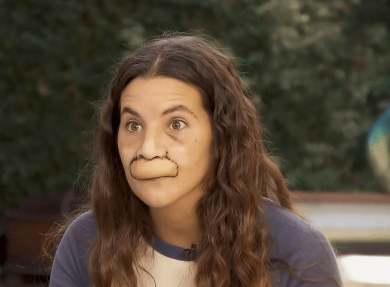 Model whose lip was bitten off by dog shows off transformation after six surgeries Model whose lip was bitten off by dog shows off transformation after six surgeries