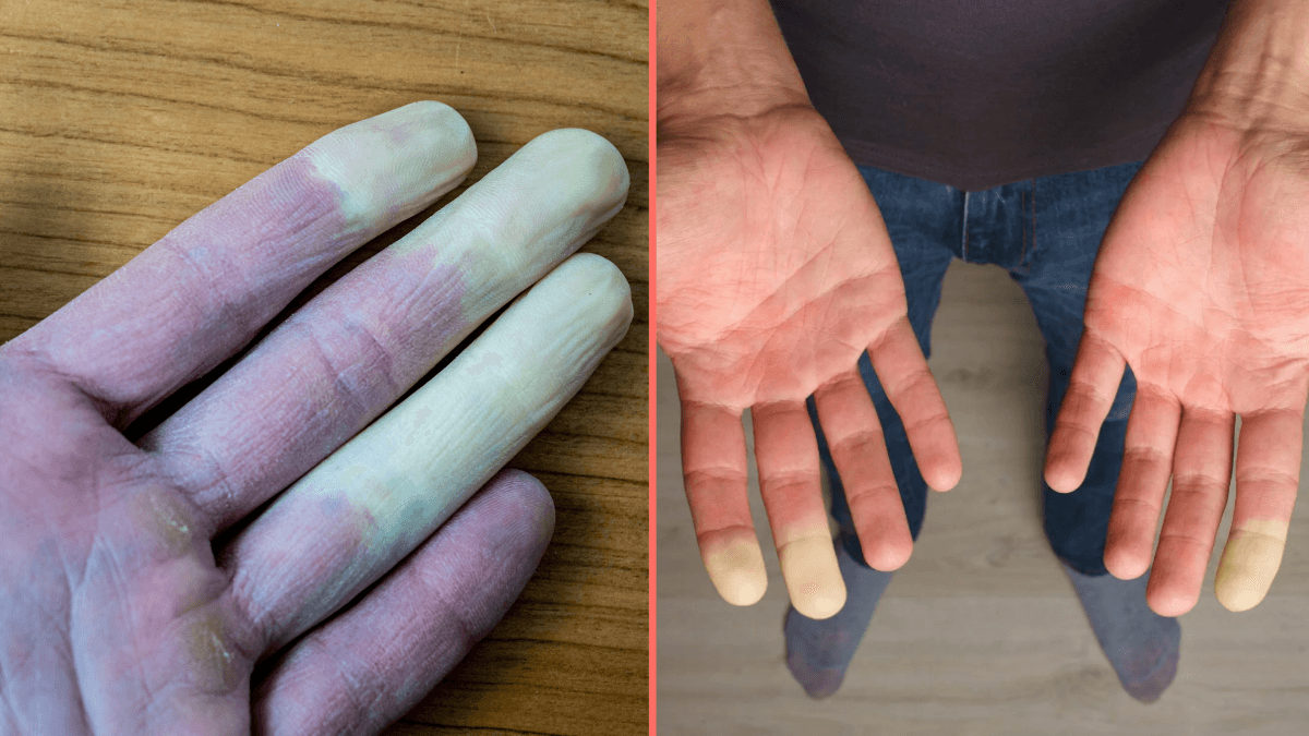 Millions of women suffer common disease where fingers turn white during winter months