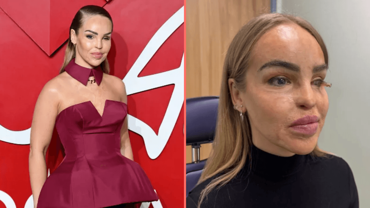 Katie Piper issues update on eye health after having it sewn shut for a year