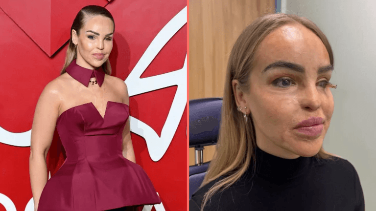 Katie Piper issues update on eye health after having it sewn shut for a year