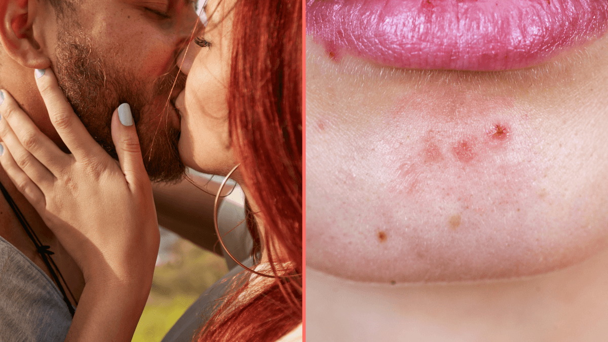Expert issues grim warning to anyone who kisses bearded men