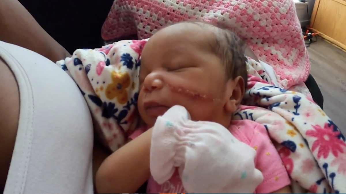Newborn needs 13 face stitches after being cut during emergency C-section