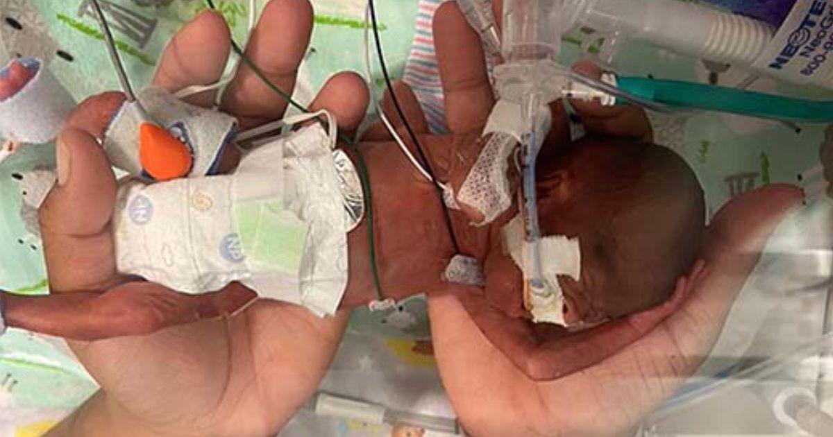 Tiny baby born at 21 weeks named the world’s most premature to survive