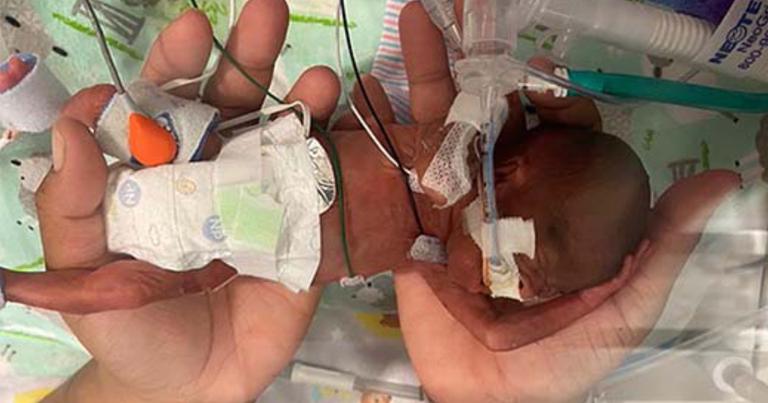 Tiny baby born at 21 weeks named the world’s most premature to survive