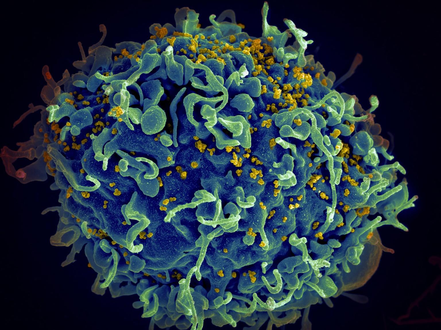 Woman cured of HIV for first time ever in ‘scientifically important’ breakthrough