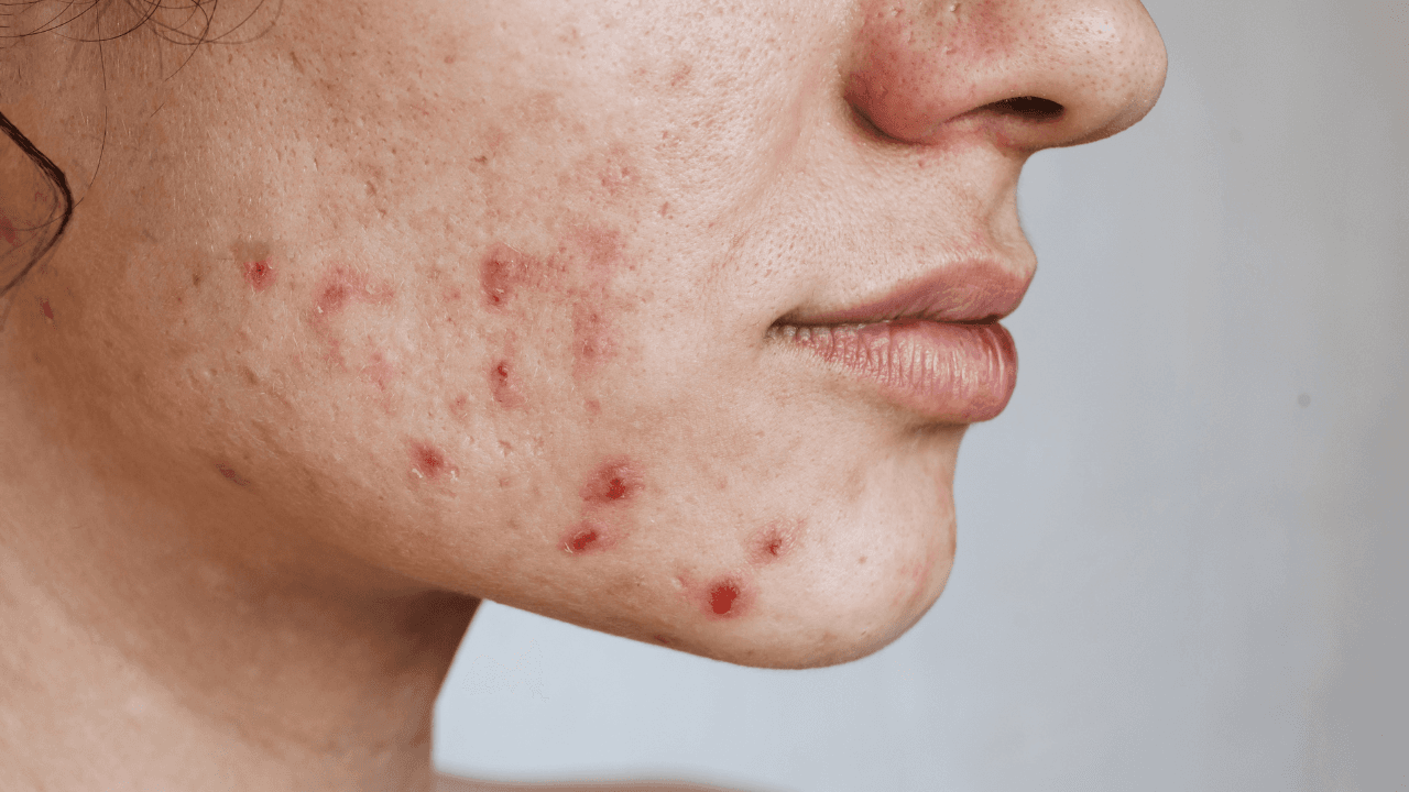 Can having acne impact your mental health? What researchers have discovered