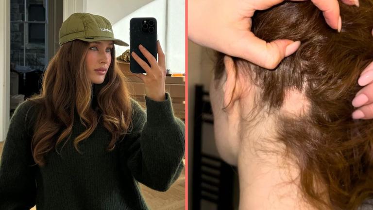 Roz Purcell issues new alopecia update following ‘bad patch’