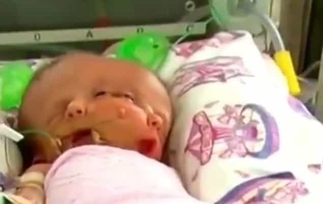‘Miracle’ Conjoined Twins Hope and Faith Have Passed Away, 19 Days Old ‘Miracle’ Conjoined Twins Hope and Faith Have Passed Away, 19 Days Old