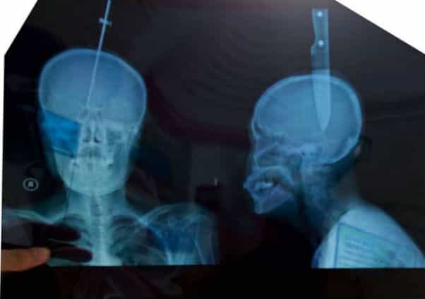Close To The Bone! Woman Survives 11cm Knife Wedged In Her Skull Close To The Bone! Woman Survives 11cm Knife Wedged In Her Skull