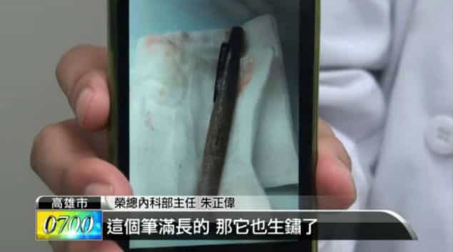 This Can’t Be Write? Woman Finds Pen Lodged In Stomach For Six Months This Can’t Be Write? Woman Finds Pen Lodged In Stomach For Six Months