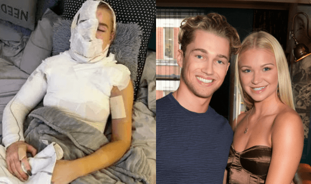 Abbie Quinnen, AJ Pritchard’s partner, pictured since suffering third degree burns Abbie Quinnen, AJ Pritchard’s partner, pictured since suffering third degree burns