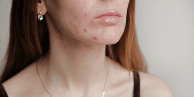 ‘This €26 acne serum worked wonders for my latest breakout’ ‘This €26 acne serum worked wonders for my latest breakout’