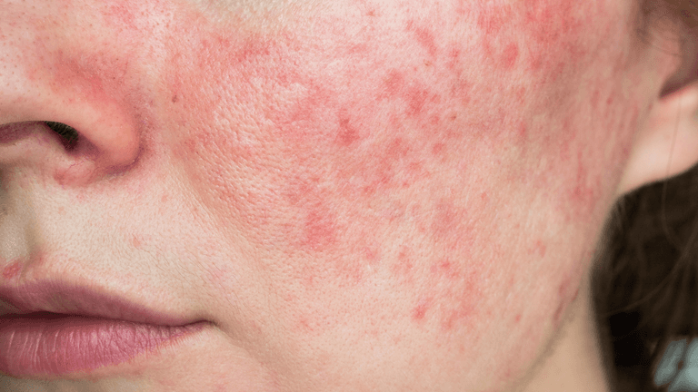This common habit can make rosacea worse This common habit can make rosacea worse