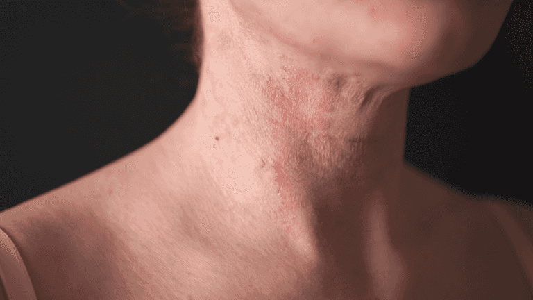 Expert reveals essential tip for preventing and treating eczema Expert reveals essential tip for preventing and treating eczema