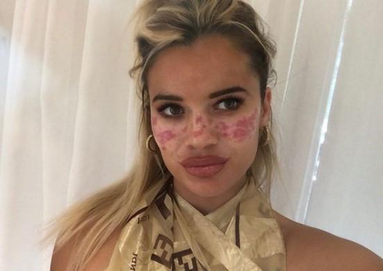 Big Brother star left temporarily blinded and scarred after TikTok DIY beauty ‘hack’ Big Brother star left temporarily blinded and scarred after TikTok DIY beauty ‘hack’