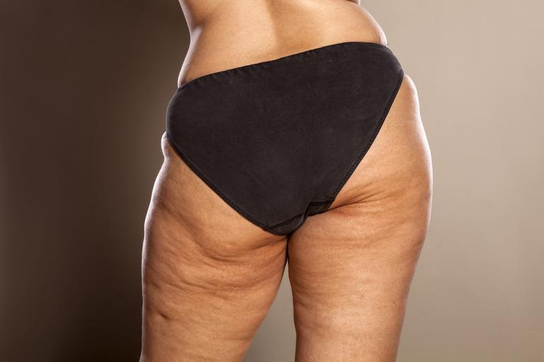 Cellulite is completely normal – but why do we get it? Cellulite is completely normal – but why do we get it?