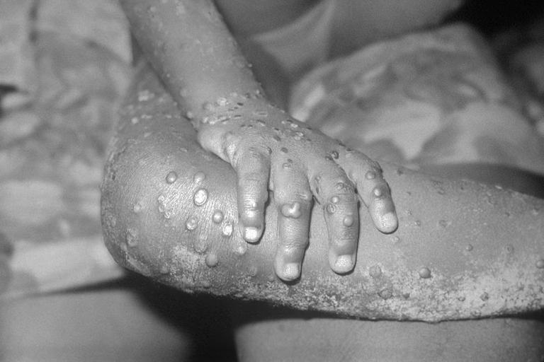 Only a matter of time before monkeypox spreads to Ireland, says expert Only a matter of time before monkeypox spreads to Ireland, says expert