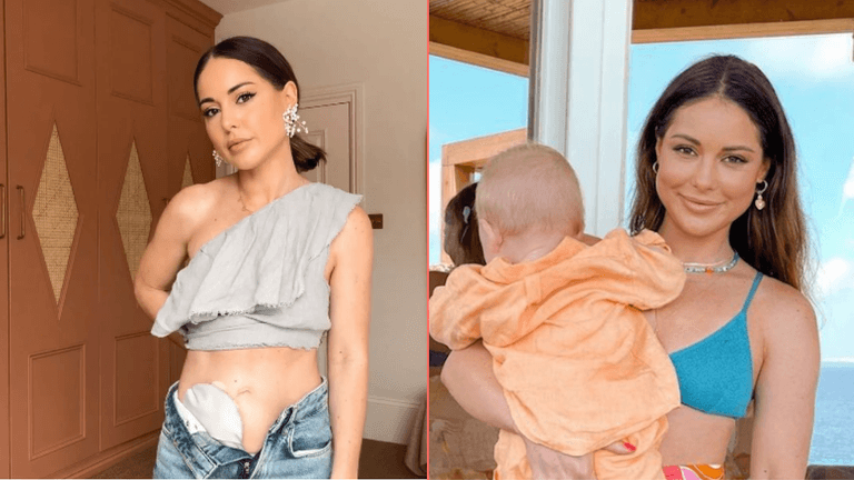 Louise Thompson praised for raising awareness about ulcerative colitis – what are the symptoms? Louise Thompson praised for raising awareness about ulcerative colitis – what are the symptoms?