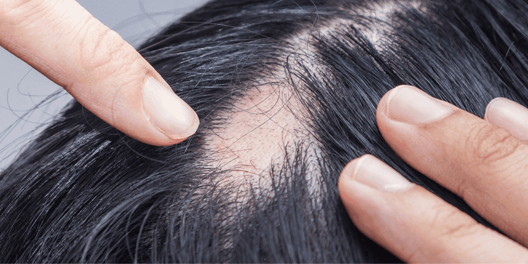 Irish woman turns her hair loss ‘into a positive story’ and is now helping others Irish woman turns her hair loss ‘into a positive story’ and is now helping others