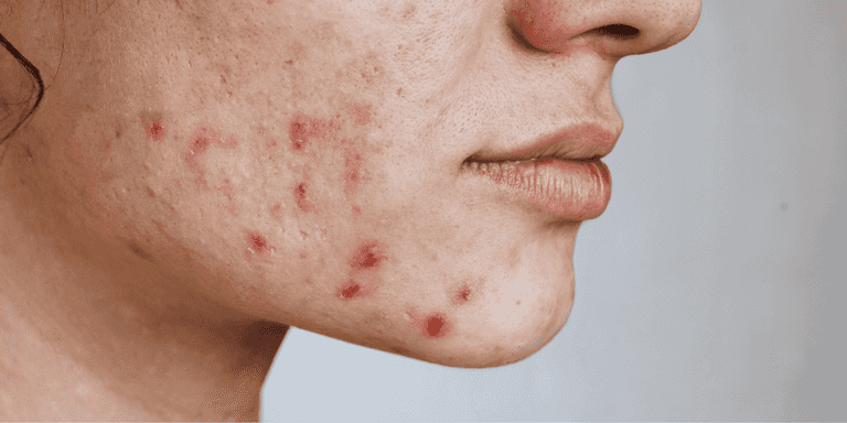 ‘Is Trentinoin going to clear my acne?’ – Dermatologist answers widely asked skincare question ‘Is Trentinoin going to clear my acne?’ – Dermatologist answers widely asked skincare question