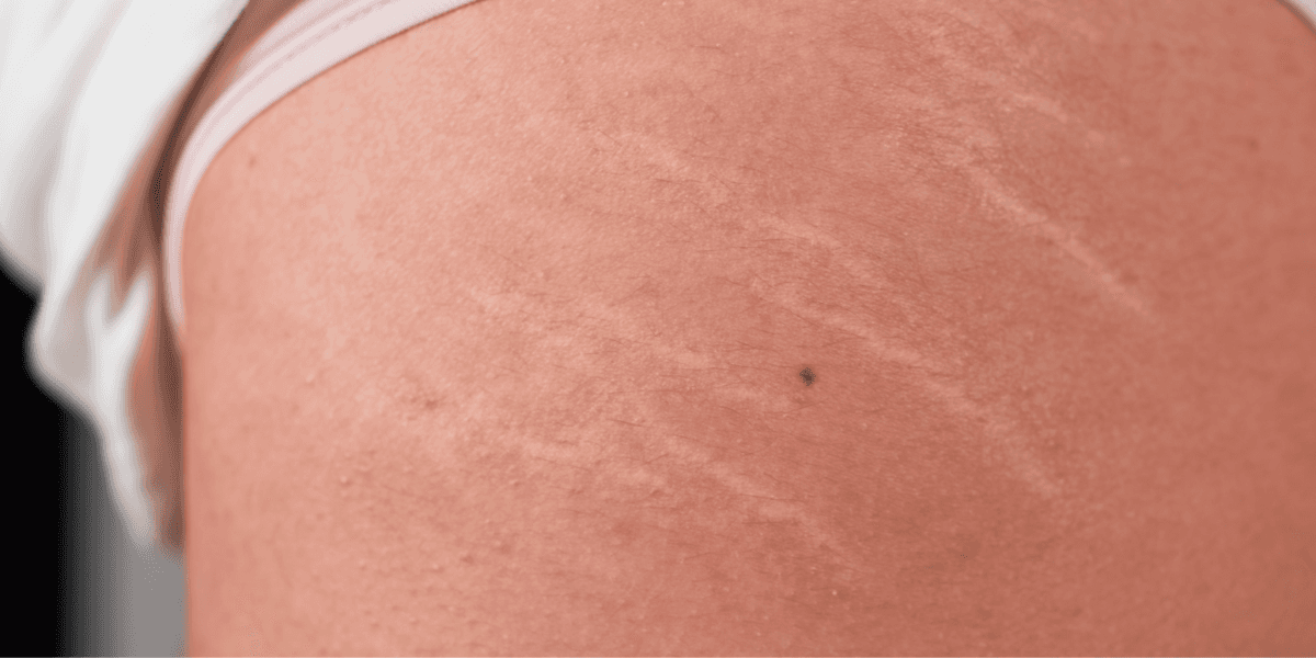 ‘Only two things work’ – Dermatologist reveals how to actually treat stretch marks