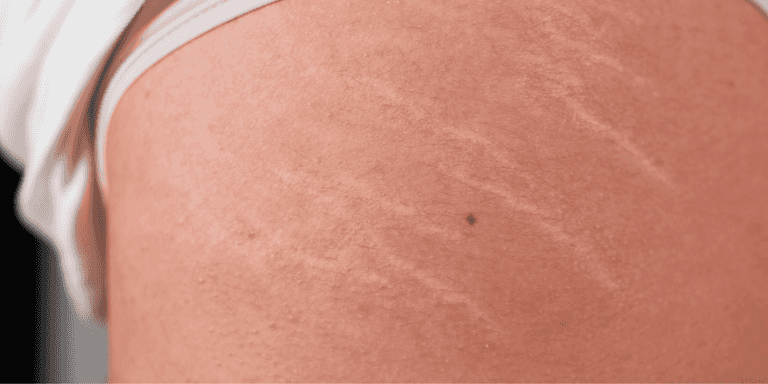 ‘Only two things work’ – Dermatologist reveals how to actually treat stretch marks ‘Only two things work’ – Dermatologist reveals how to actually treat stretch marks