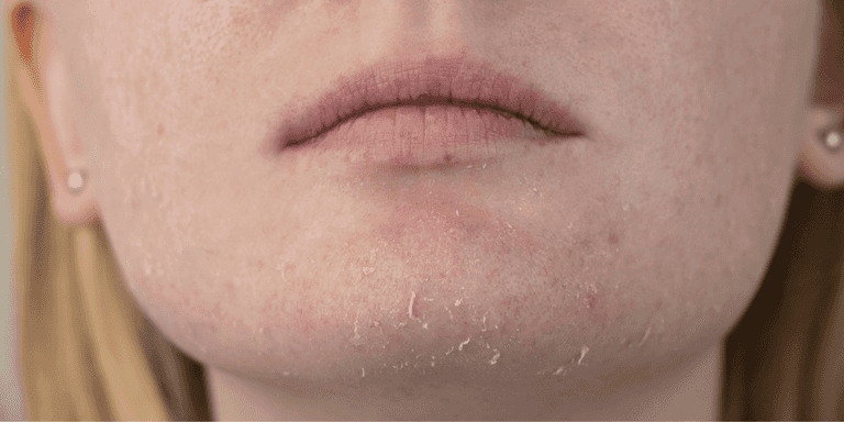 What is seborrheic dermatitis? The common skin condition affecting thousands of women What is seborrheic dermatitis? The common skin condition affecting thousands of women