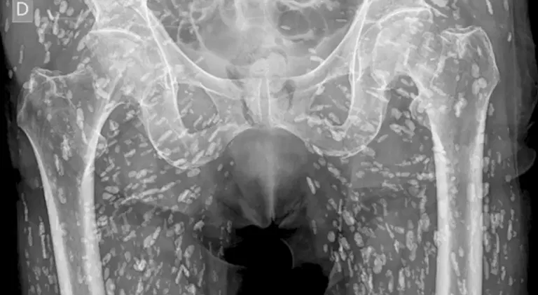 Horrifying X-ray shows tapeworms breeding inside man’s body after he made vital kitchen error Horrifying X-ray shows tapeworms breeding inside man’s body after he made vital kitchen error