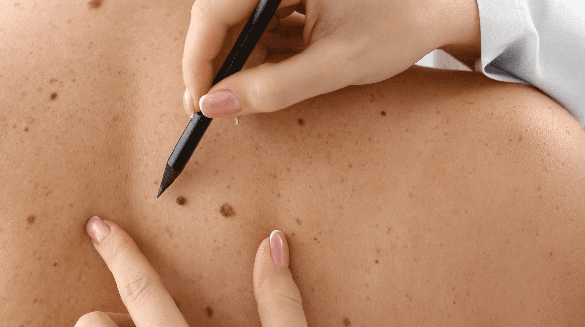 Skin cancer survival rates are improving in Ireland