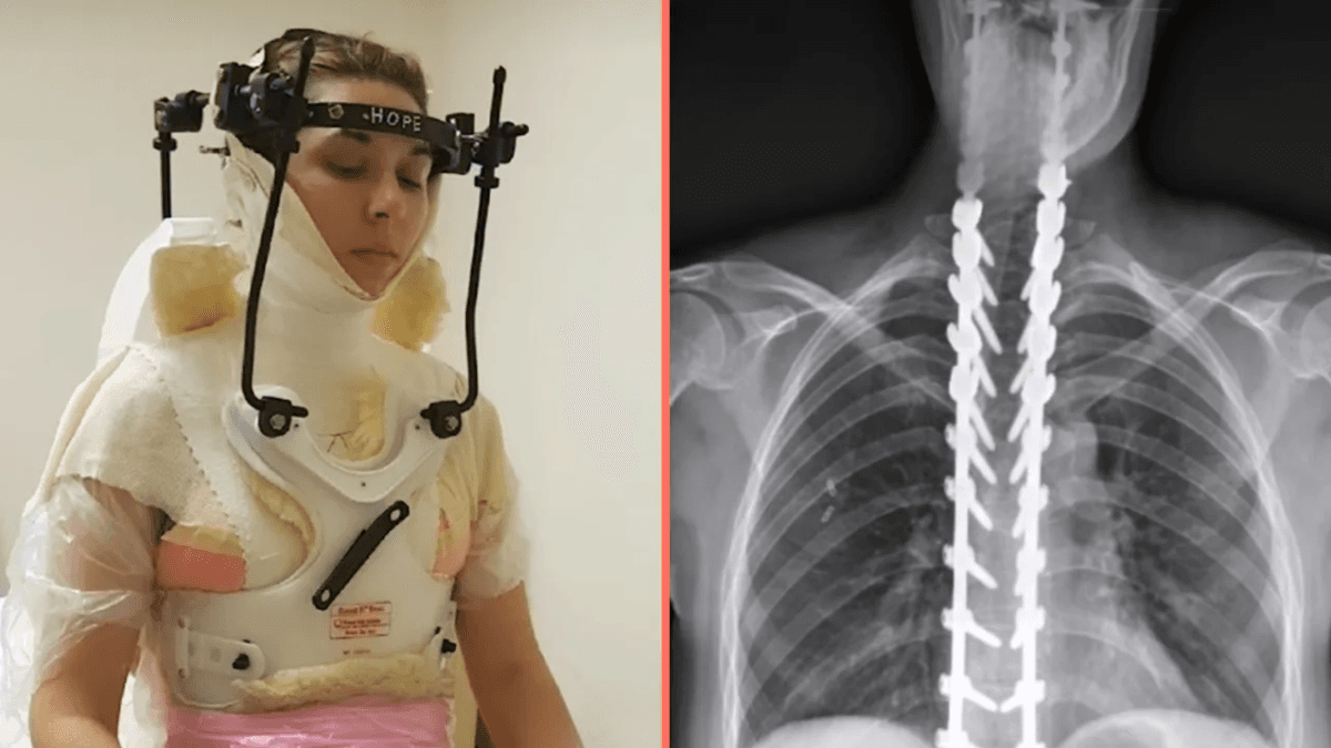 Woman has skull reattached after being ‘decapitated’ in freak football injury