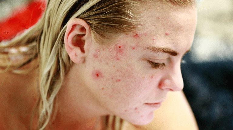 Irish skincare expert reveals what actually causes adult acne Irish skincare expert reveals what actually causes adult acne